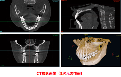 CT撮影画像（3次元の情報）